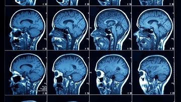 This Brain Implant will change the Healthcare System