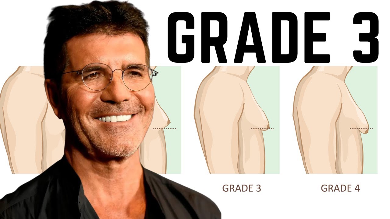 Gynecomastia Grade 3 Treatment: Achieving Optimal Results - YouTube