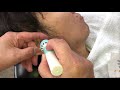 【床屋の耳掃除】2020.4.1 電動耳かき　男性モデル　おばあちゃんの耳掃除　イヤースコープ  イヤークリーナー　耳カス