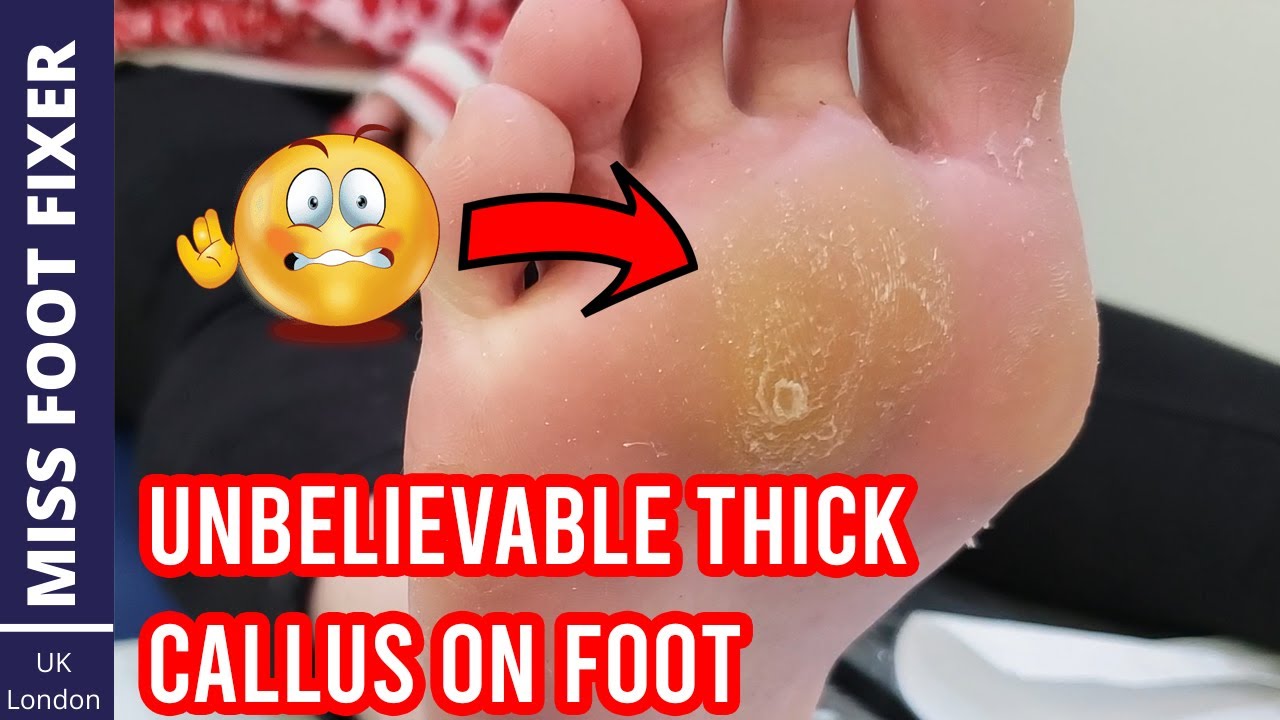 SATISFYING THICK FOOT CALLUS REMOVAL BY MISS FOOT FIXER MARION YAU 