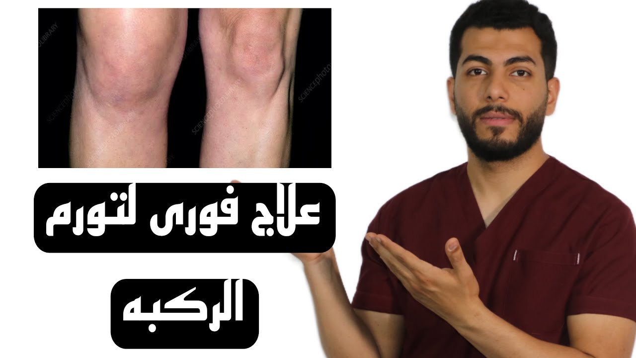 تورم الركبة: الأسباب الخفية والعلاج الفعال لتخفيف الألم فوراً!