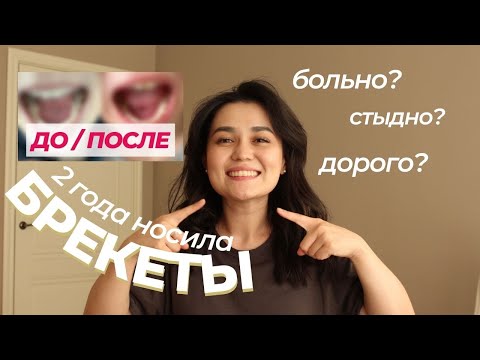 ПОСМОТРИ прежде, чем ставить брекеты | ДО И ПОСЛЕ, мой опыт, история, советы