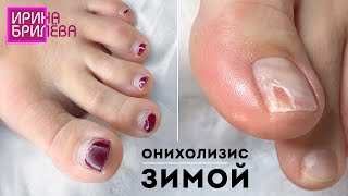 ПЕДИКЮР  🌸 Как обрабатывать онихолизис в зимний период 🌸 Ирина Брилёва