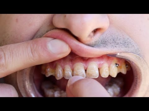 AGGA Made My Teeth Loose - YouTube
