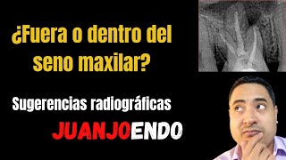 Dentro o fuera del seno maxilar. SUGERENCIAS radiográficas