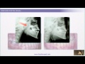 The Case for Rewards of Correcting Rest Oral Posture - William M. Hang, DDS, MSD