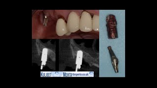 Upper molar Implant Removal by Dr Kuljeet Singh Mehta-Periodontist 1,144 views 2 years ago 4 minutes, 57 seconds