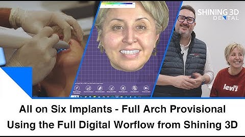 All On Six Implants I Temporary Full Arch Rehabilitation I Shining 3D Full Digital Workflow