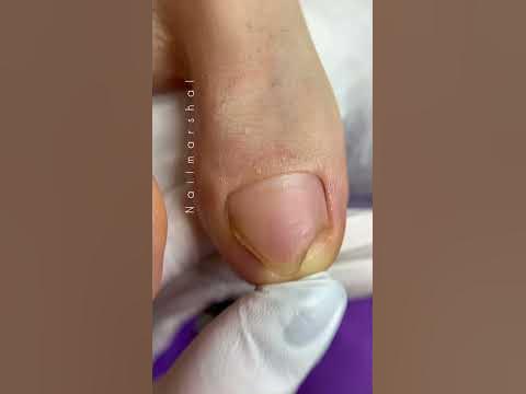 Динамика #педикюрмосква #подологмосква #подология - YouTube