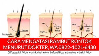 CARA MENGATASI RAMBUT RONTOK MENURUT DOKTER, WA 0822 1021 6430