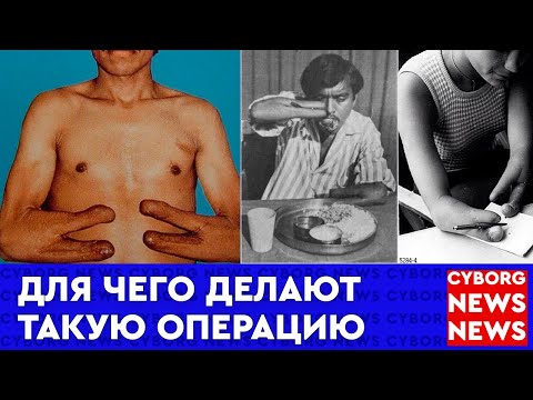 Операцию по расщеплению культи по методу Крукенберга или современный протез руки  факты