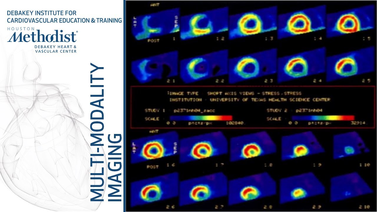Chest Pain the the ED: What Imaging Modality? (M. Quiñones, MD and F. Nabi, MD) February 12, 2019 cardiology site
