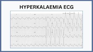 Hyperkalaemia ECG Changes Explained