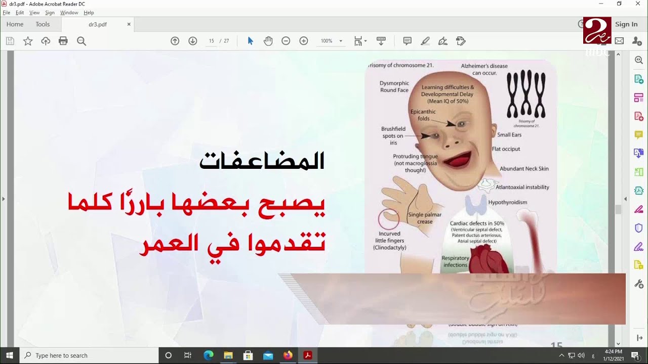 مضاعفات خطيرة ممكن يتعرض لها الطفل المصاب بمتلازمة داون