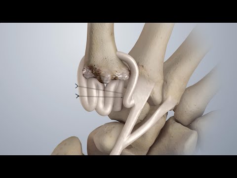 Kleinert Kutz Synovectomy Rongeur