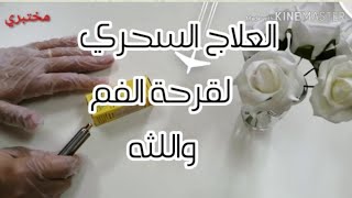 العلاج السحري لقرحة الفم واللثه
من تجربتي الشخصيه