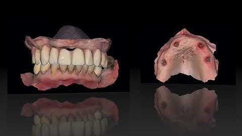 Evo+ Full Arch Digital Workflow