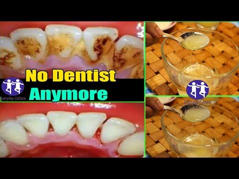 NO DENTIST ANYMORE! In 2 minutes Remove plaque from teeth