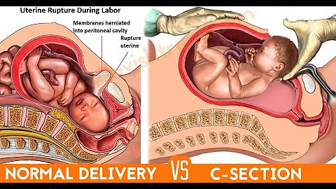 Medical Animation: Cesarean Delivery - DayDayNews