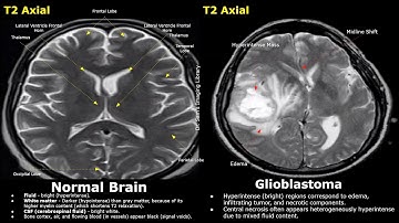 MRI Brain Normal Vs Glioblastoma T2 & FLAIR Imaging Findings | High Grade Aggressive Tumors