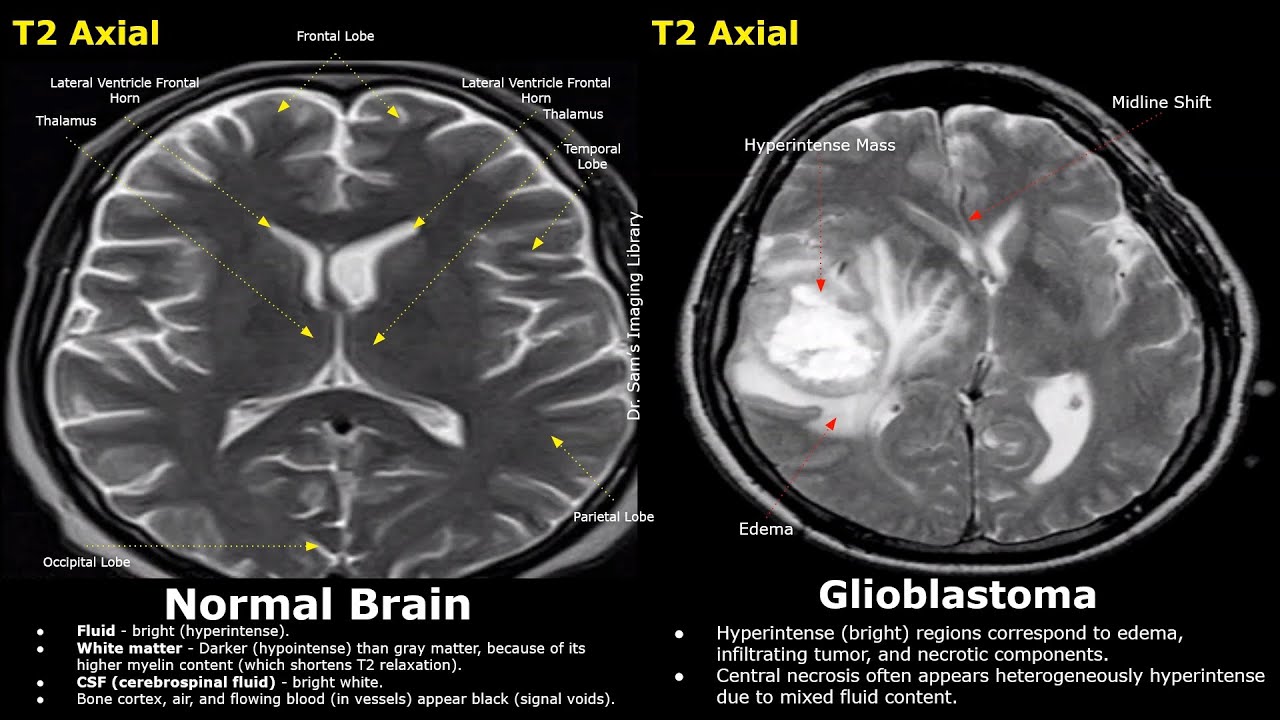 Нормальные результаты МРТ головного мозга против глиобластомы T2 и FLAIR | Высокозлокачественные ...
