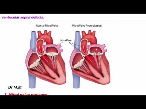 Heart Murmurs Explained: