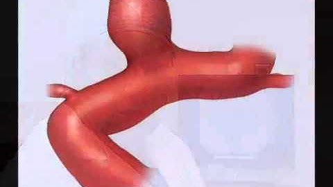 Flow Diversion for Intracranial Aneurysms   Mayo Clinic