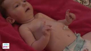 Learn to Spot the Warning Signs of SMA – Belly Breathing and Bell-Shaped Chest (Video 1)