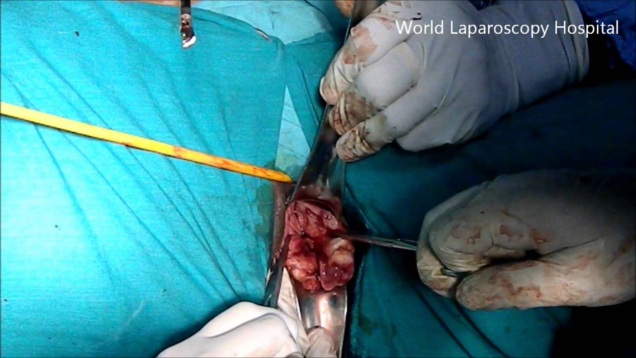 Subincision Subincision