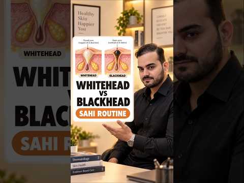 Whiteheads vs Blackheads: Dono Pe Same Cream Mat Lagana!
