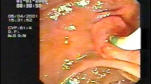 Endoscopy Master Videos: ERCP Cannulation & sphincterotomy @ www.gastroliver.com.sg