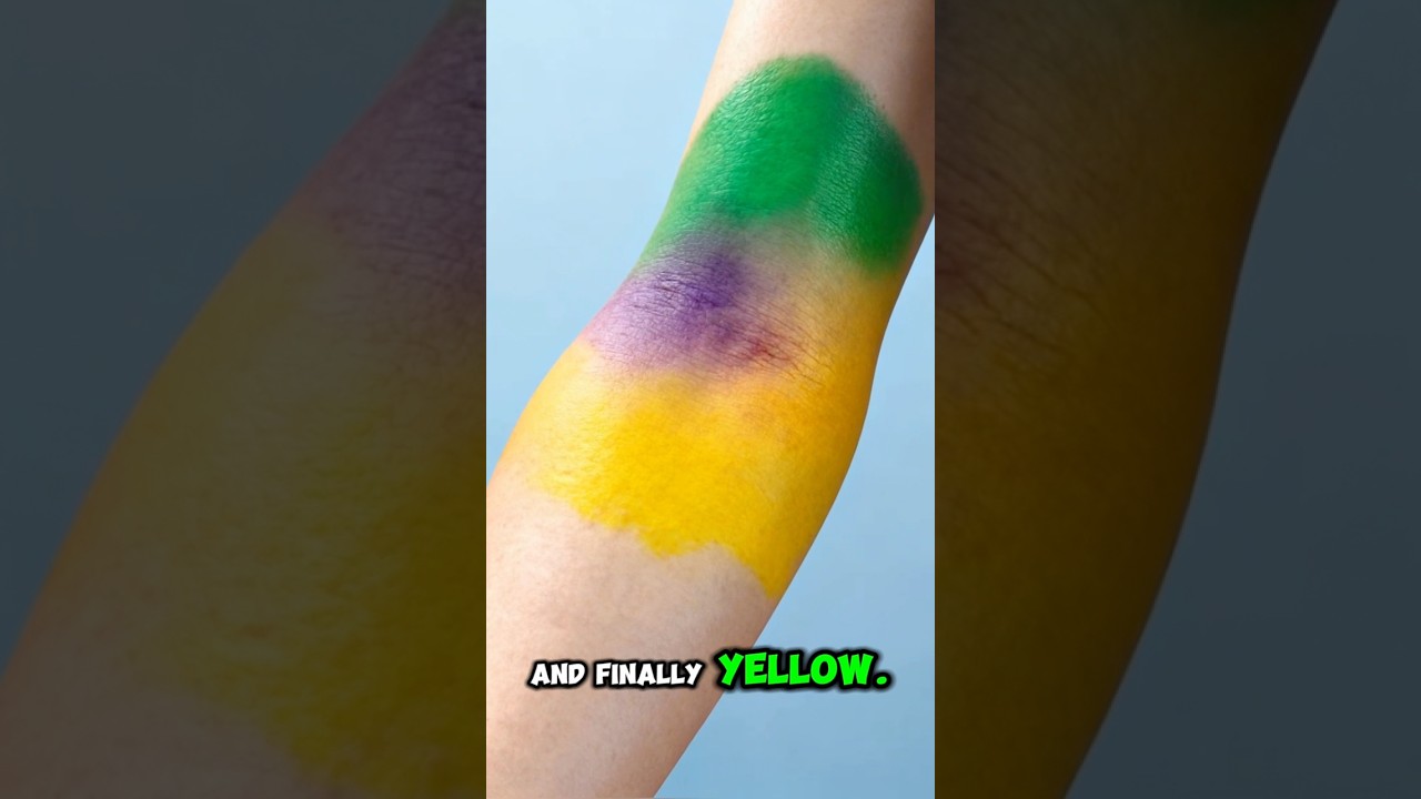 What Really Happens Under Your Skin When You Get a Bruise