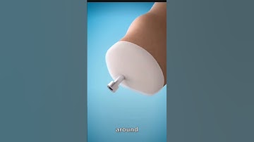 "Bionic Arm Technology Explained: A Second Chance at Mobility!" In india