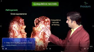 Necrosis and types of Necrosis , General pathology - Animated usmle videos screenshot 5