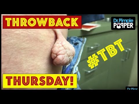 Reminiscing With Dr Pimple Popper TBT Part 12