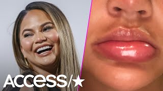 Chrissy Teigen's Massively Swollen Lip Was 'About To Explode' For This Alarming Reason