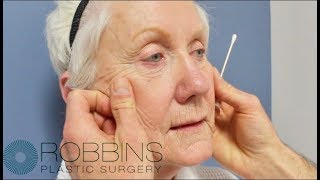 FACELIFT SURGERY- Award Winning \\