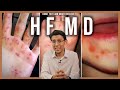 HFMD : Ketahui Tanda-tanda dan Langkah Pencegahan