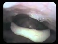 Laryngoscopy: Healthy young female opera singer singing