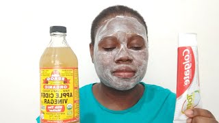 APPLYING COLGATE TOOTHPASTE AND APPLE CIDER VINEGAR ON MY FACE FOR CLEARER SKIN