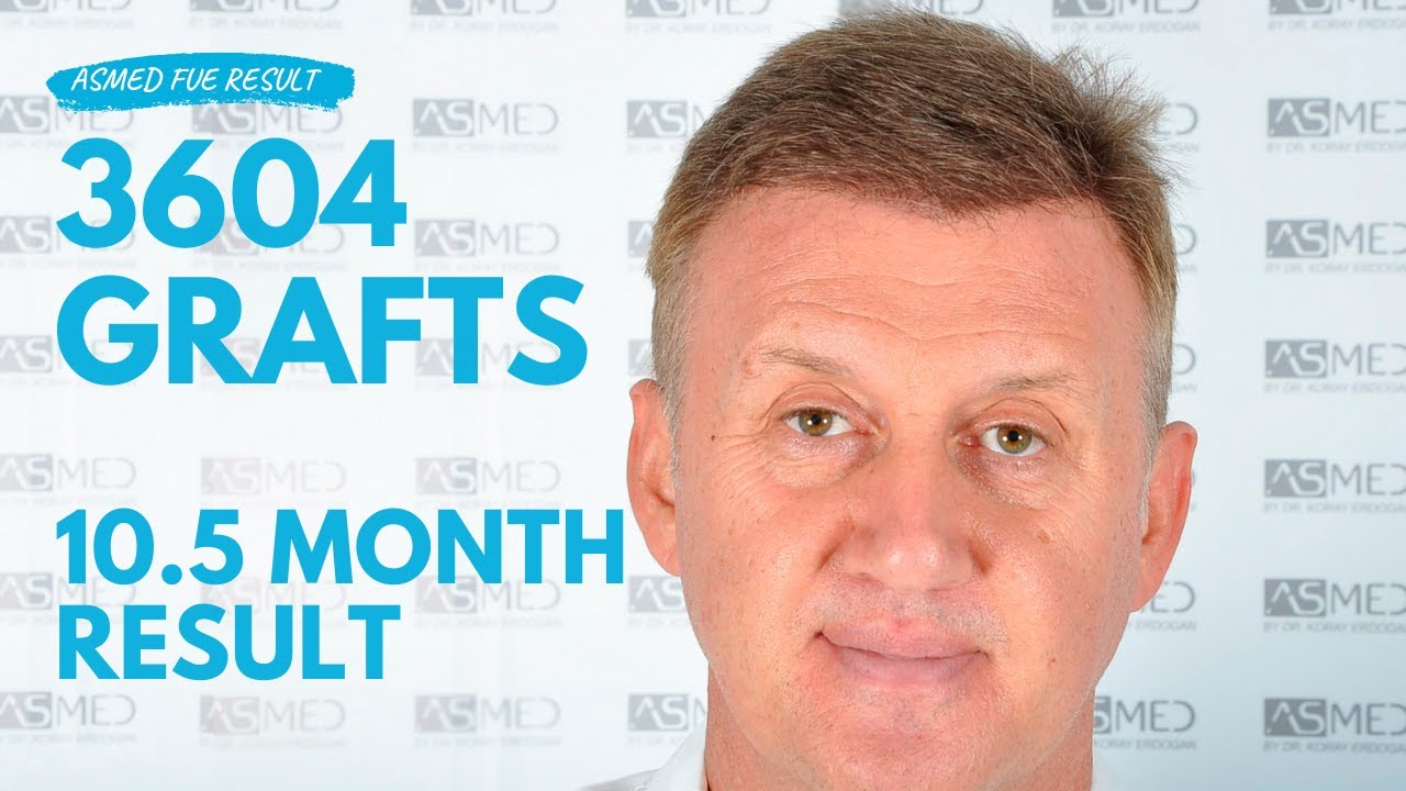 3604 графтов - Результат пересадки методом Fue