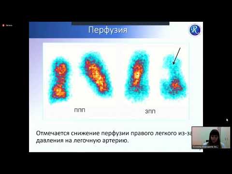 Кочкина М.А. Клинический разбор: "Рак легкого после травмы органов грудной клетки"