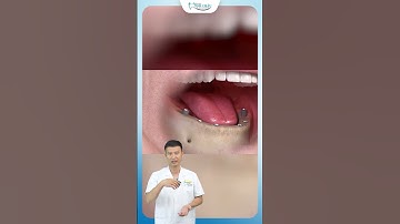 Quy Trình Trồng Răng Implant Toàn Hàm | Bác Sĩ Yên