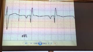 د. أشرف زكي ECG 1