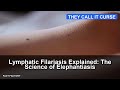 Lymphatic Filariasis Explained: The Science of Elephantiasis