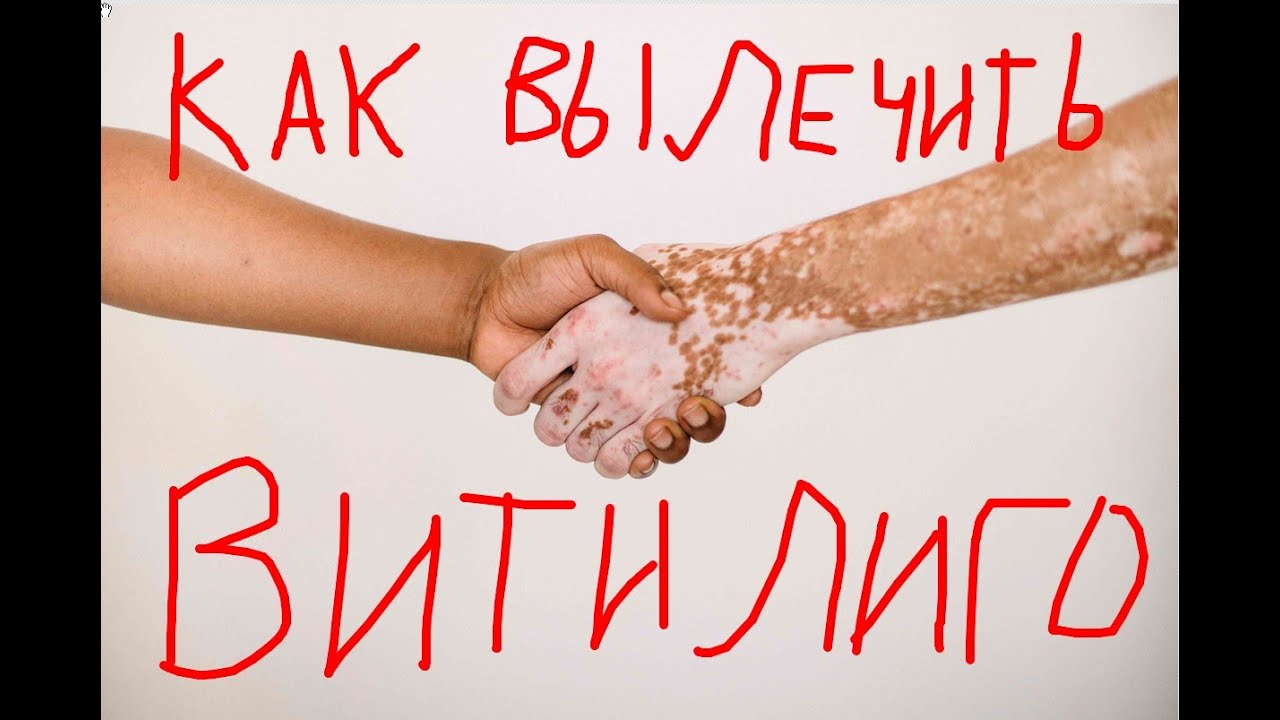 ЕДИНСТВЕННЫЙ 100% СПОСОБ ВЫЛЕЧИТЬ ВИТИЛИГО - YouTube