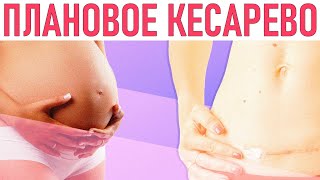 ПЛАНОВОЕ КЕСАРЕВО СЕЧЕНИЕ | Что нужно знать про кесарево сечение