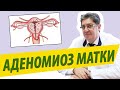 Аденомиоз матки. Внутренний эндометриоз. Признаки, лечение