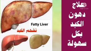 أسهل علاج لدهون وتشحم الكبد Fatty Liver