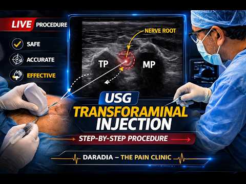 Ultrasound Guided Transforaminal epidural Injection – Step by Step Technique